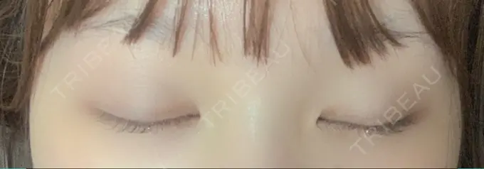 二重埋没 湘南美容クリニック 赤坂見附院 AFTER メイン用