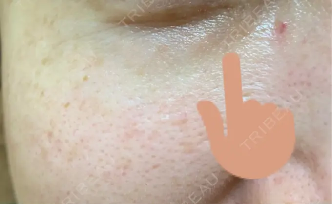 クマ治療 / 下まぶたたるみ取り / 下まぶたの脂肪取り 韓国ST美容整形外科 DAY 194 メイン用