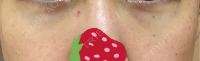 クマ治療 / 下まぶたたるみ取り / 下まぶたの脂肪取り 韓国ST美容整形外科 DAY 209 メイン用