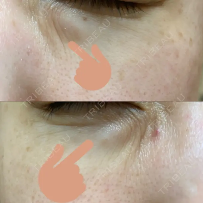 クマ治療 / 下まぶたたるみ取り / 下まぶたの脂肪取り 韓国ST美容整形外科 DAY 209 メイン用