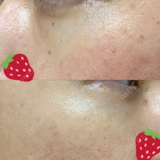 クマ治療 / 下まぶたたるみ取り / 下まぶたの脂肪取り 韓国ST美容整形外科 DAY 209 メイン用