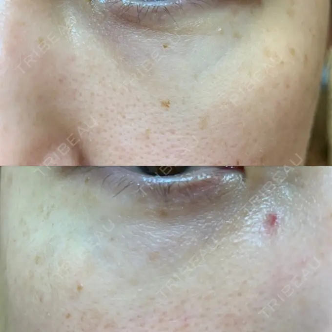 クマ治療 / 下まぶたたるみ取り / 下まぶたの脂肪取り 韓国ST美容整形外科 DAY 223 メイン用