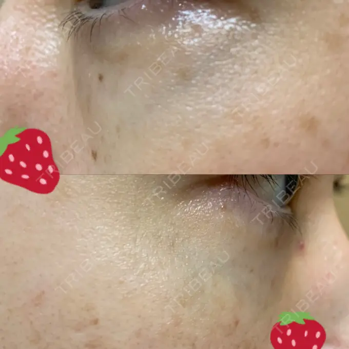 クマ治療 / 下まぶたたるみ取り / 下まぶたの脂肪取り 韓国ST美容整形外科 DAY 223 メイン用