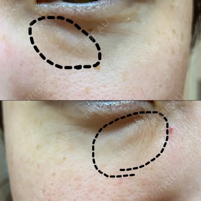 クマ治療 / 下まぶたたるみ取り / 下まぶたの脂肪取り 韓国ST美容整形外科 DAY 223 メイン用