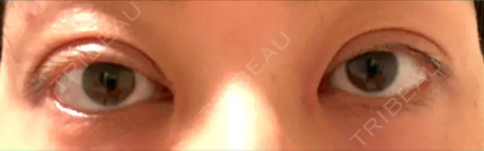 二重切開 / 目頭切開 きくな湯田眼科 DAY 12 メイン用