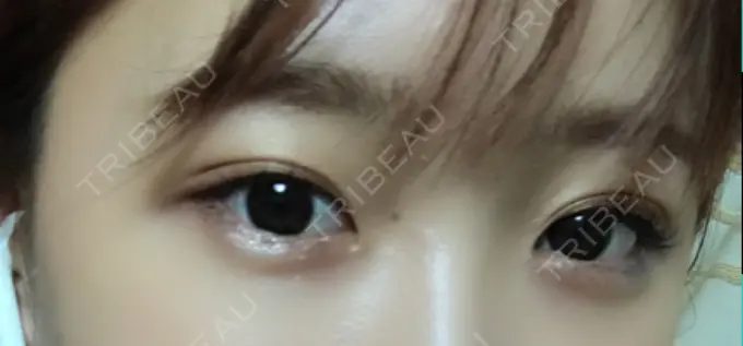 ヒアルロン酸注入（涙袋） しのぶ皮膚科 DAY 0 メイン用