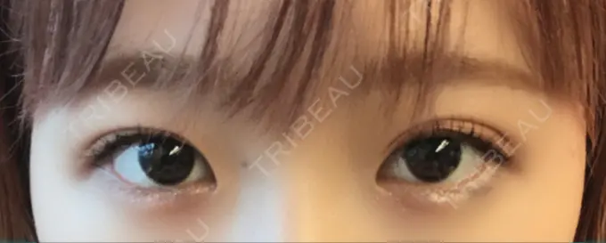 ヒアルロン酸注入（涙袋） しのぶ皮膚科 DAY 0 メイン用