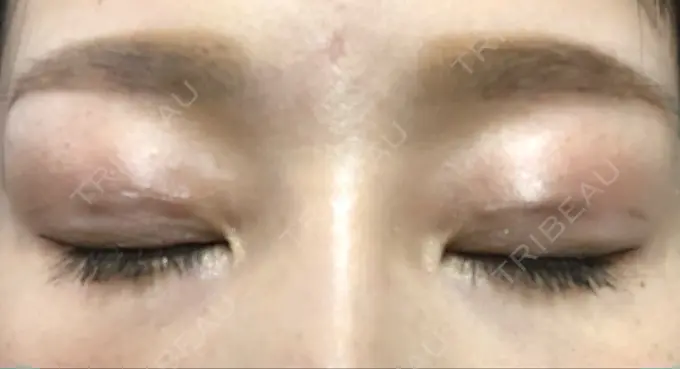 二重埋没 湘南美容クリニック 福島院 DAY 43 メイン用