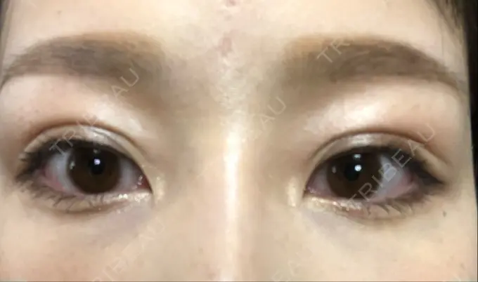 二重埋没 湘南美容クリニック 福島院 DAY 43 メイン用