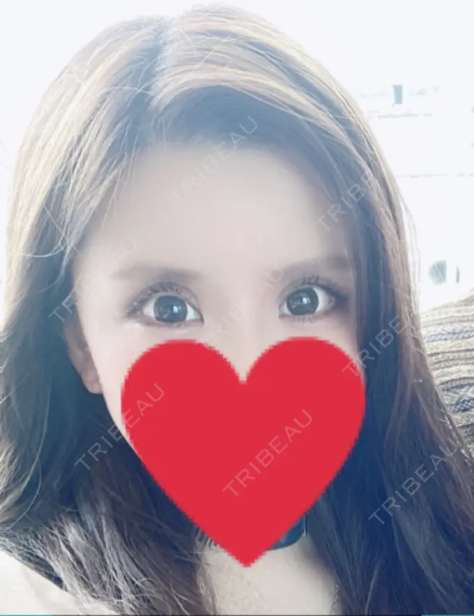 二重切開 / 目元修正 心斎橋コムロ美容外科クリニック DAY 80 メイン用