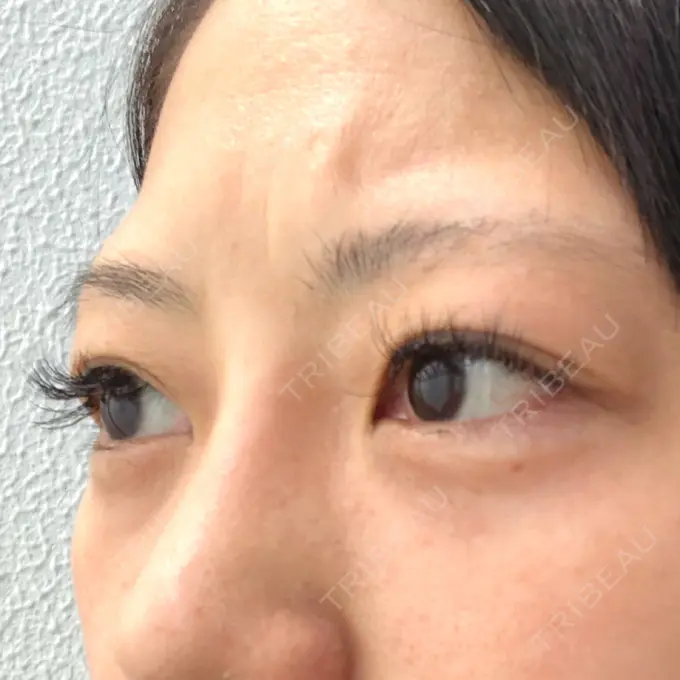 クマ治療 / タレ目形成・グラマラスライン（切開） / その他（目元） BIANCA銀座 DAY 81 メイン用