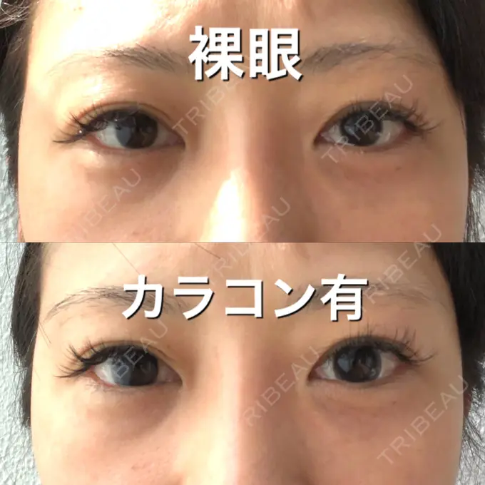 クマ治療 / タレ目形成・グラマラスライン（切開） / その他（目元） BIANCA銀座 DAY 81 メイン用