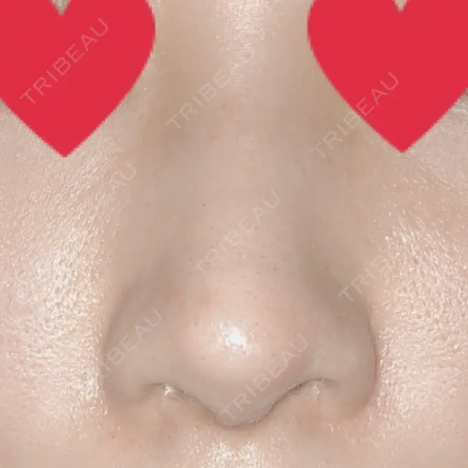 軟骨移植 / 骨切幅寄せ / ワシ鼻修正・ハンプ切除 / 鼻孔縁下降 加美（GAMI）整形外科 DAY 19 メイン用