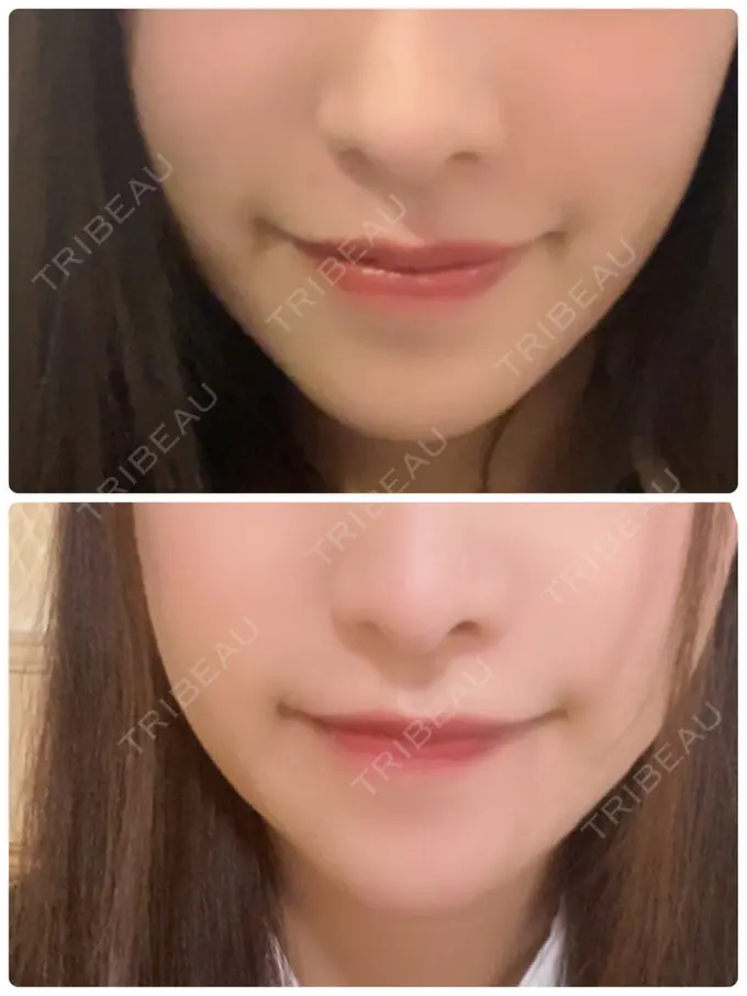 あごプロテーゼ / 骨切り（あご） / 脂肪吸引（顔） 心斎橋コムロ美容外科クリニック DAY 186 メイン用