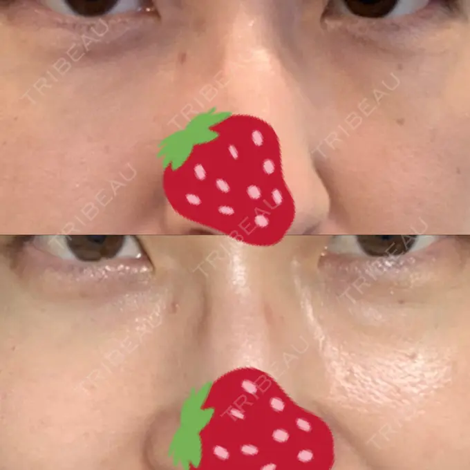 クマ治療 / 下まぶたたるみ取り / 下まぶたの脂肪取り 韓国ST美容整形外科 DAY 297 メイン用