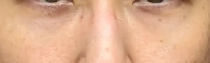 クマ治療 / 下まぶたたるみ取り / 下まぶたの脂肪取り 韓国ST美容整形外科 AFTER メイン用