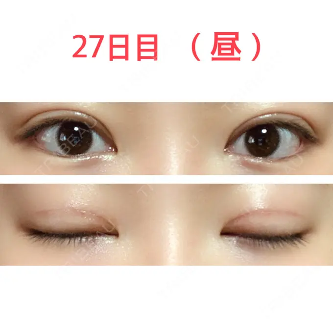 二重切開 水の森美容クリニック 東京新宿院 DAY 27 メイン用