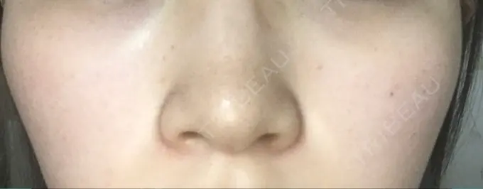 ボトックス（口角） / ピーリング（ニキビ・毛穴） / ピコレーザートーニング（美白・肝斑） 美容皮膚科 369 clinic DAY 56 メイン用