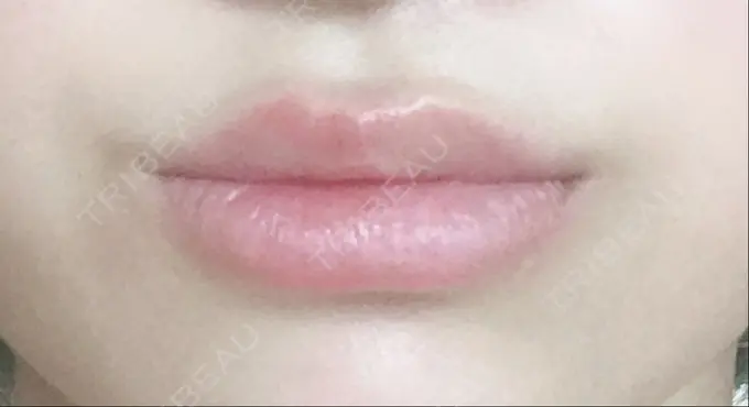 ボトックス（口角） / ピーリング（ニキビ・毛穴） / ピコレーザートーニング（美白・肝斑） 美容皮膚科 369 clinic DAY 61 メイン用