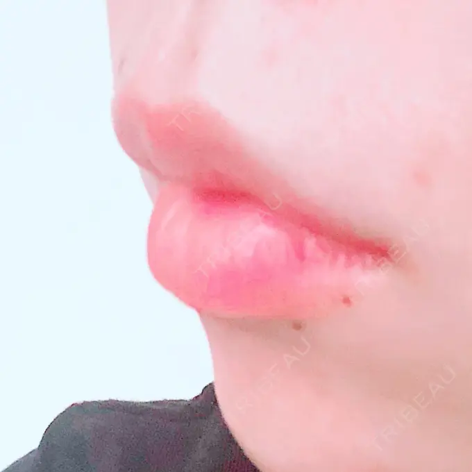 ヒアルロン酸注入（唇） / ボトックス（口角） ルラ美容クリニック 高田馬場院 DAY 1 メイン用