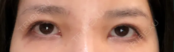 眼瞼下垂（切開） あきこクリニック DAY 98 メイン用