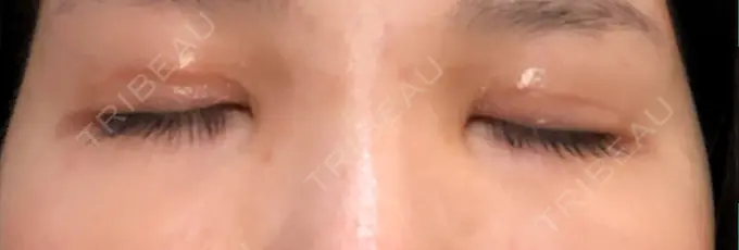 眼瞼下垂（切開） あきこクリニック DAY 98 メイン用