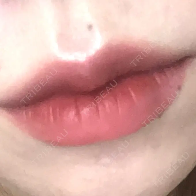 ヒアルロン酸注入（唇） / ボトックス（口角） ルラ美容クリニック 高田馬場院 DAY 2 メイン用
