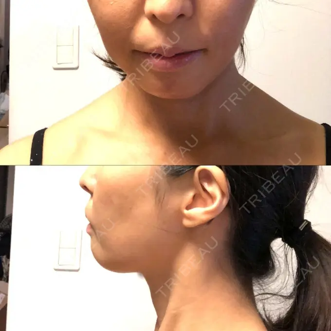 あごプロテーゼ ティーズクリニック DAY 19 メイン用