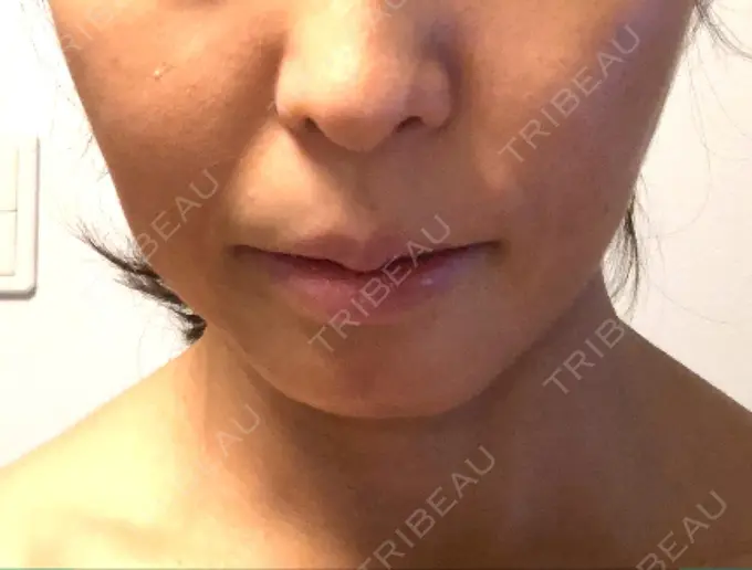 あごプロテーゼ ティーズクリニック DAY 19 メイン用