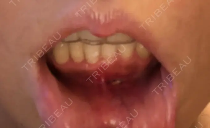 あごプロテーゼ ティーズクリニック DAY 19 メイン用