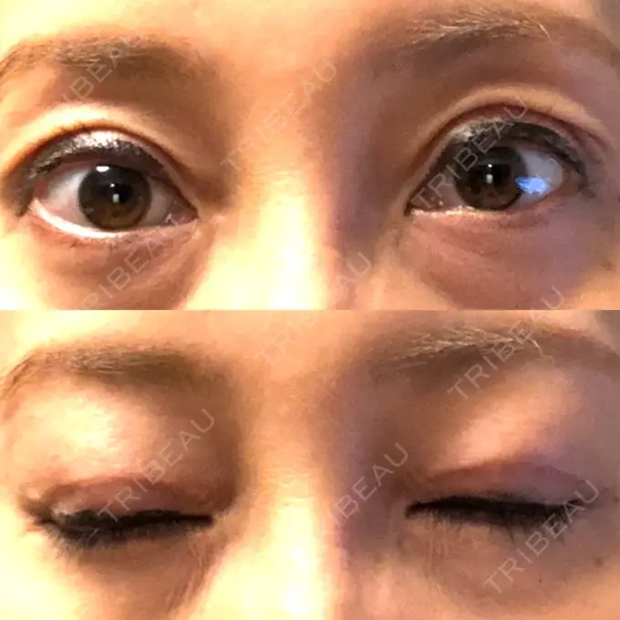 眼瞼下垂（切開） ティーズクリニック DAY 20 メイン用