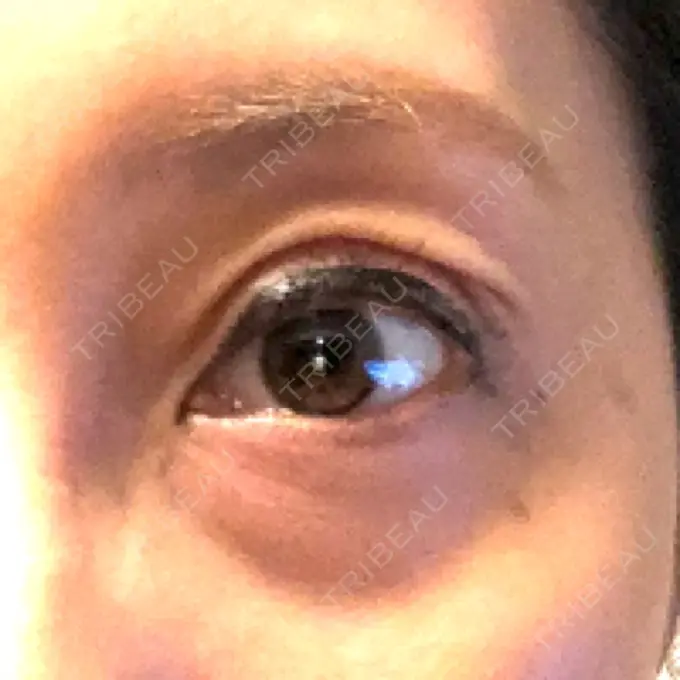 眼瞼下垂（切開） ティーズクリニック DAY 20 メイン用