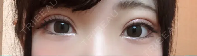 二重埋没 十仁美容整形 DAY 6 メイン用