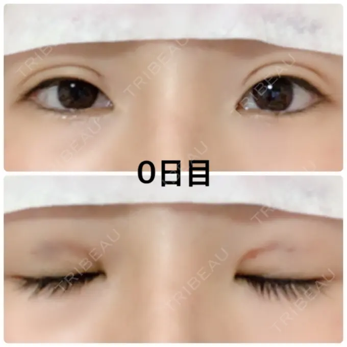 二重埋没 湘南美容クリニック 京都院 DAY 0 メイン用