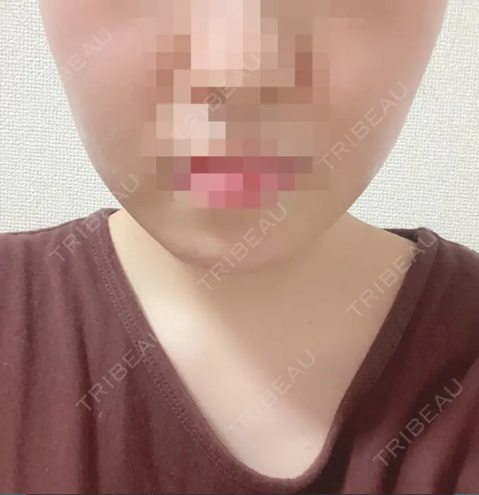 脂肪吸引（顔） アサミ美容外科 渋谷院 DAY 19 メイン用