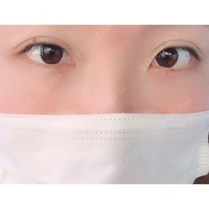 二重埋没 湘南美容クリニック 姫路院 DAY 0 メイン用