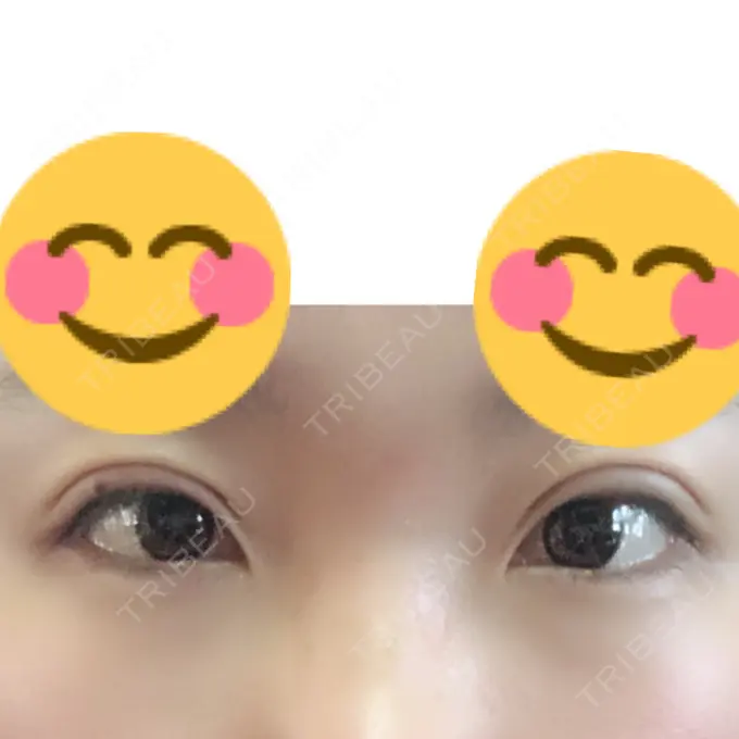 二重埋没 湘南美容クリニック 姫路院 DAY 1 メイン用