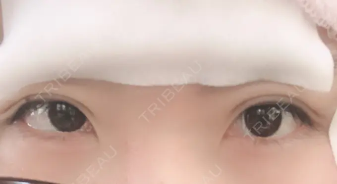 二重埋没 湘南美容クリニック 姫路院 DAY 2 メイン用