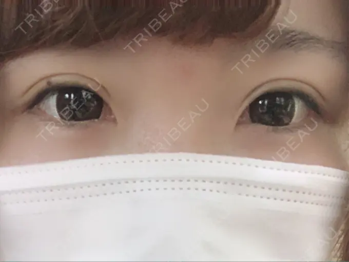 二重埋没 湘南美容クリニック 姫路院 DAY 3 メイン用