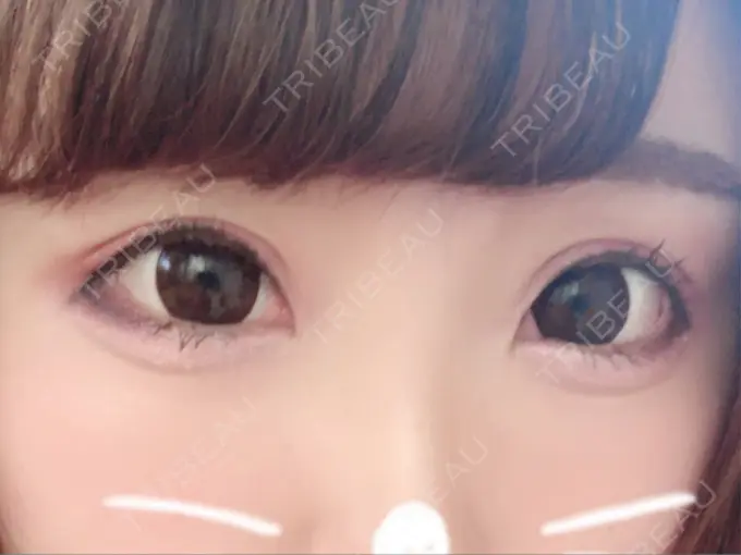 二重埋没 湘南美容クリニック 姫路院 DAY 4 メイン用