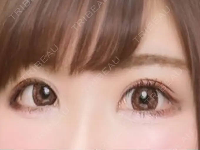 二重埋没 湘南美容クリニック 姫路院 DAY 5 メイン用