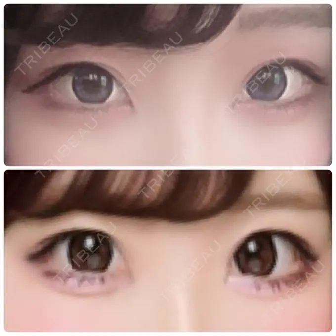 二重埋没 湘南美容クリニック 姫路院 AFTER メイン用