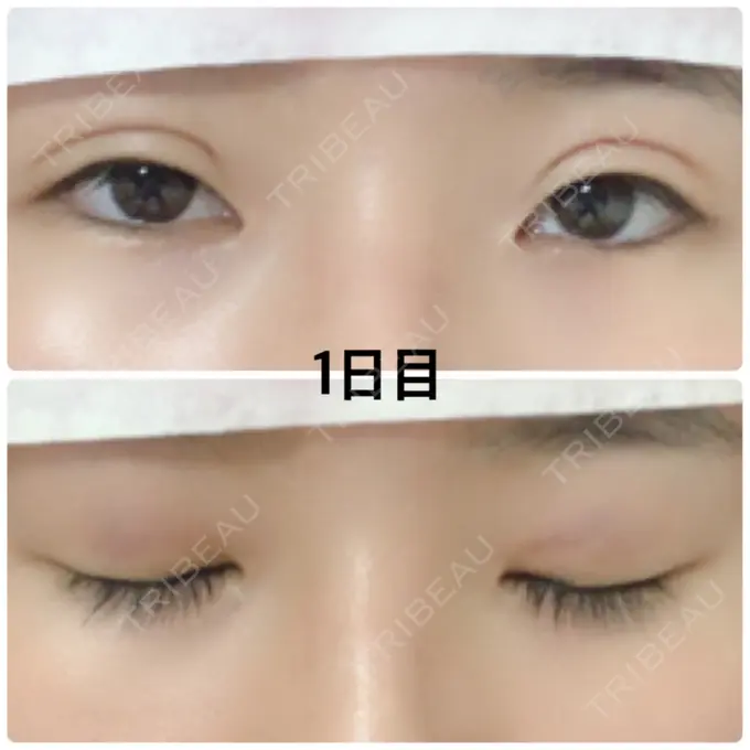 二重埋没 湘南美容クリニック 京都院 DAY 1 メイン用