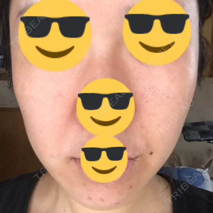 水光注射（ハリ・美肌） / 脂肪溶解注射（顔） / その他（肌） / 美白レーザー / ピコレーザートーニング（美白・肝斑） / 医療脱毛（脚） リエンジャン整形外科 江南店 AFTER メイン用