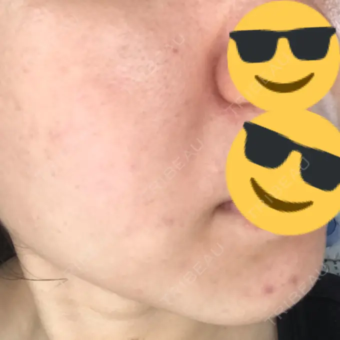 水光注射（ハリ・美肌） / 脂肪溶解注射（顔） / その他（肌） / 美白レーザー / ピコレーザートーニング（美白・肝斑） / 医療脱毛（脚） リエンジャン整形外科 江南店 DAY 156 メイン用