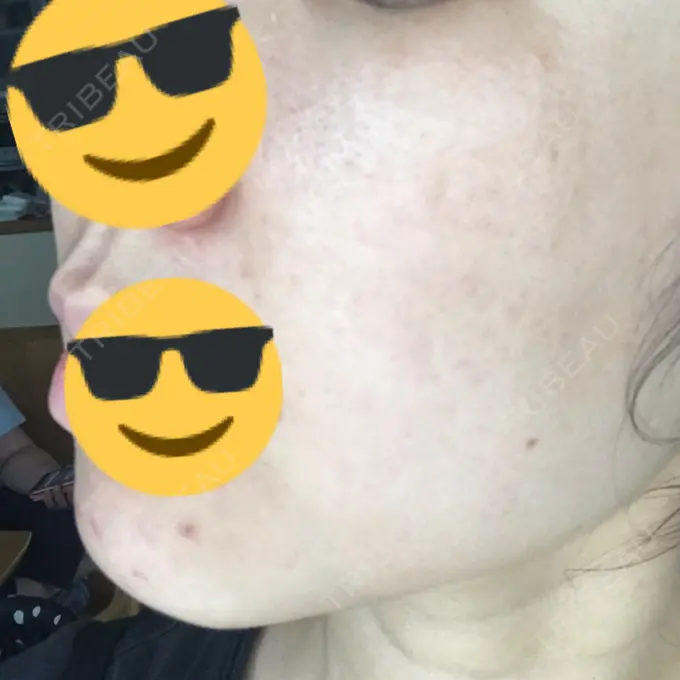 水光注射（ハリ・美肌） / 脂肪溶解注射（顔） / その他（肌） / 美白レーザー / ピコレーザートーニング（美白・肝斑） / 医療脱毛（脚） リエンジャン整形外科 江南店 DAY 156 メイン用