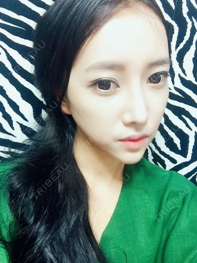 二重埋没 / 隆鼻術 / 鼻尖形成（切開） / 鼻中隔延長（切開） / 骨切り（あご） / 骨削り（エラ） / 骨削り（頬） / 軟骨移植 / ワシ鼻修正・ハンプ切除 DA美容外科 DAY 91 メイン用