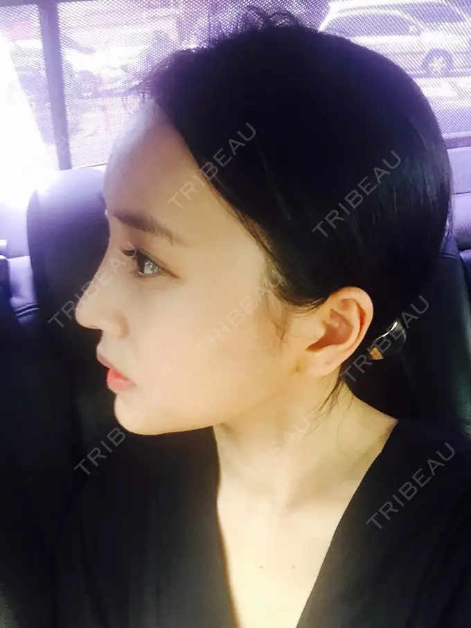 二重埋没 / 隆鼻術 / 鼻尖形成（切開） / 鼻中隔延長（切開） / 骨切り（あご） / 骨削り（エラ） / 骨削り（頬） / 軟骨移植 / ワシ鼻修正・ハンプ切除 DA美容外科 DAY 91 メイン用