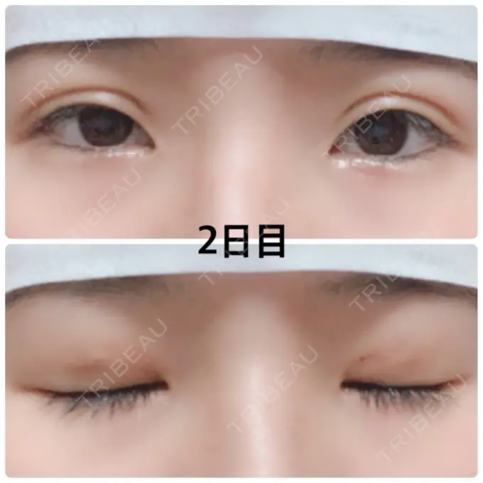 二重埋没 湘南美容クリニック 京都院 DAY 2 メイン用