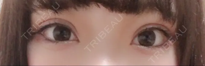 二重埋没 十仁美容整形 DAY 7 メイン用